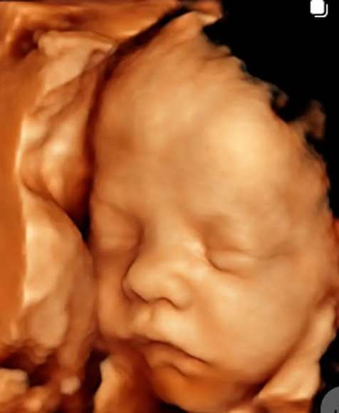Imagem de ultrassom obstétrico 3D feita na clínica
